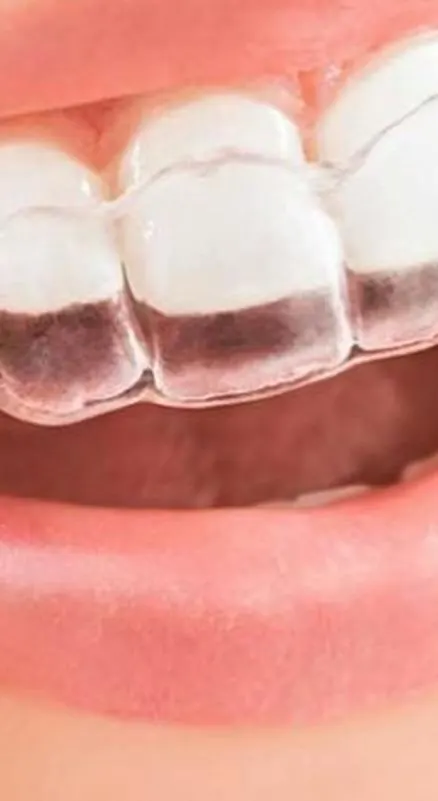 Alineadores invisibles en Elite Clinic Dental & Medical, Bosques de las Lomas, CDMX