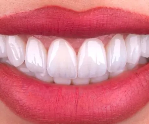Carillas dentales en Elite Clinic Dental & Medical, Bosques de las Lomas, CDMX