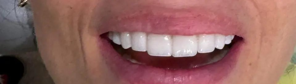 Después de carillas dentales, caso de la Dra. Juliana Pucciarelli en Bosques de las Lomas, CDMX