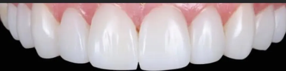 Después de carillas dentales, caso de la Dra. Juliana Pucciarelli en Bosques de las Lomas, CDMX