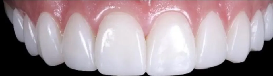 Después de carillas dentales, caso de la Dra. Juliana Pucciarelli en Bosques de las Lomas, CDMX