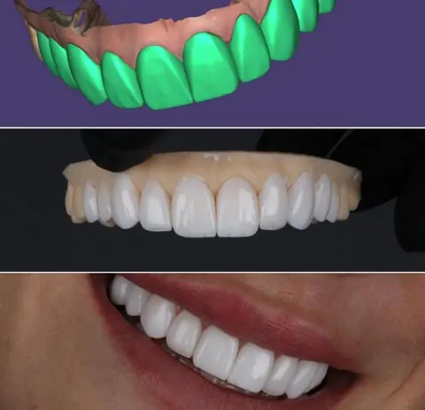 Diseño de sonrisa digital y carillas en Elite Clinic Dental & Medical, CDMX